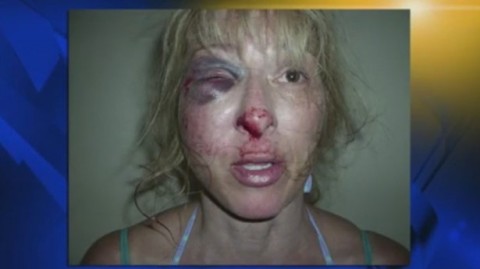 Christina West, after police beating